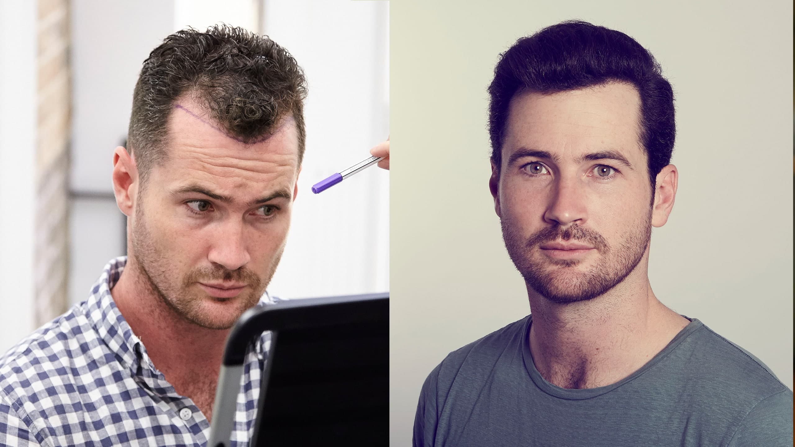 Hair Transplant UK – Restore Your Confidence with Expert Care